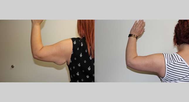 Upper Arm Lift: Image #623