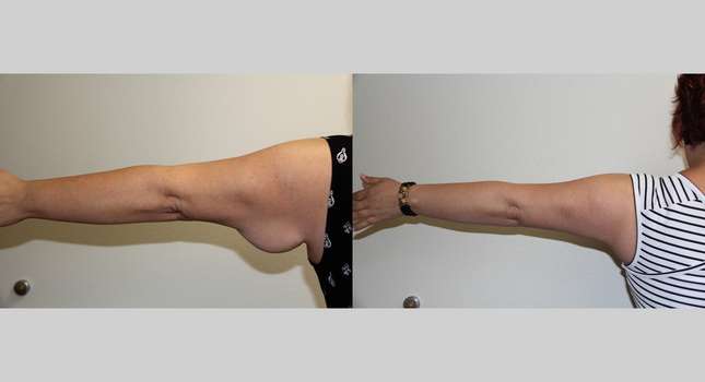 Upper Arm Lift: Image #624
