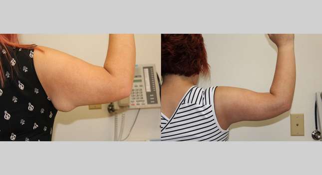 Upper Arm Lift: Image #625