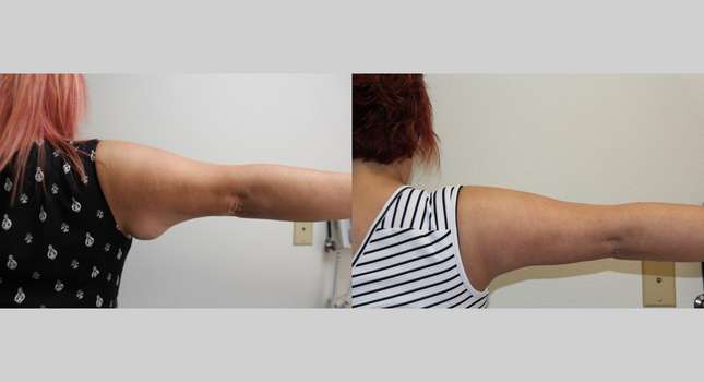 Upper Arm Lift: Image #626