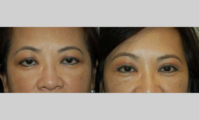 Forehead and Brow Lift: Image #632