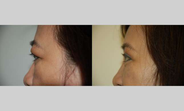 Forehead and Brow Lift: Image #633
