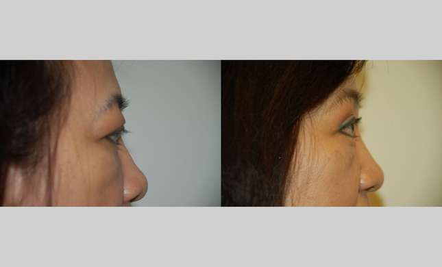 Forehead and Brow Lift: Image #634
