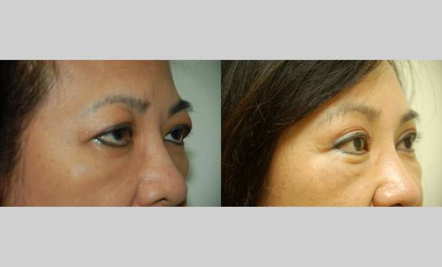 Forehead and Brow Lift: Image #635