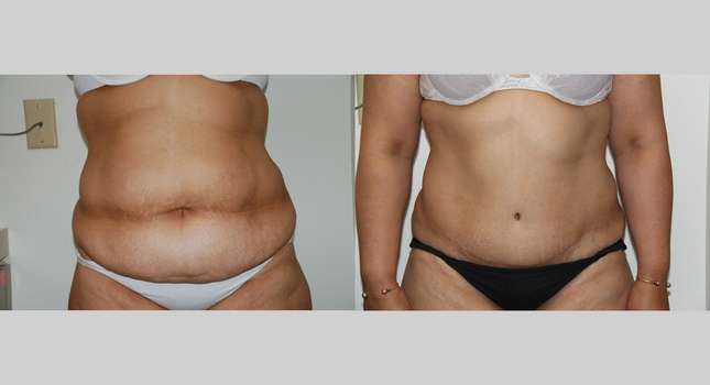 Tummy Tuck: Image #647