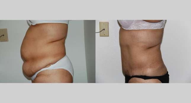 Tummy Tuck: Image #648