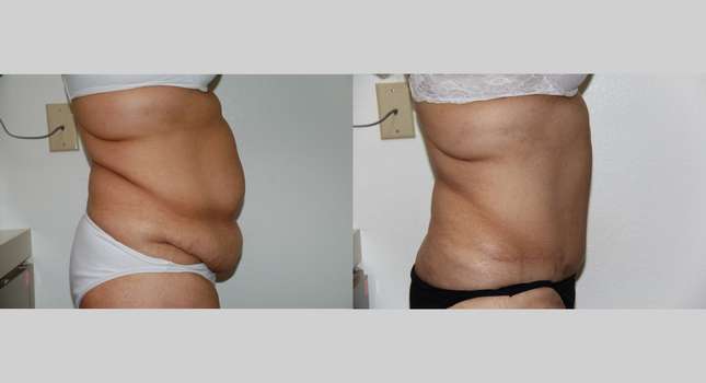 Tummy Tuck: Image #649