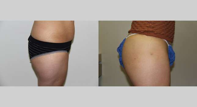 Butock and Thigh Contouring: Image #650