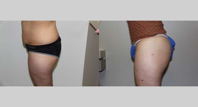 Butock and Thigh Contouring: Image #651