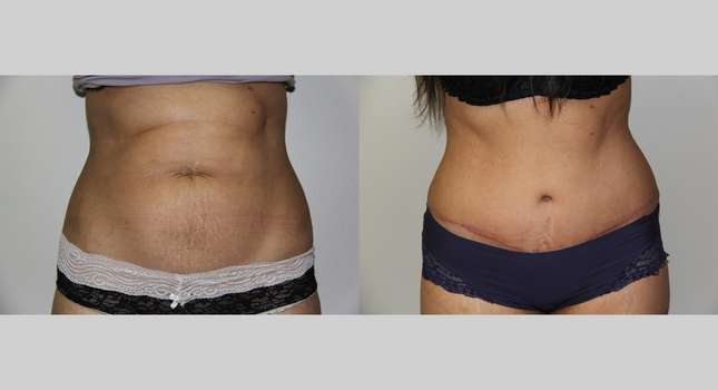 Tummy Tuck: Image #655