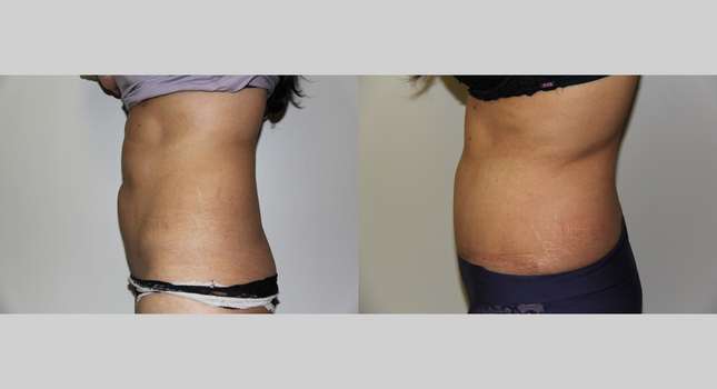 Tummy Tuck: Image #656