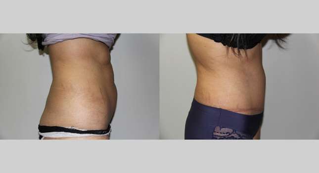 Tummy Tuck: Image #657