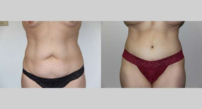 Tummy Tuck: Image #669