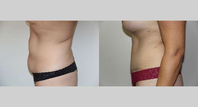 Tummy Tuck: Image #670