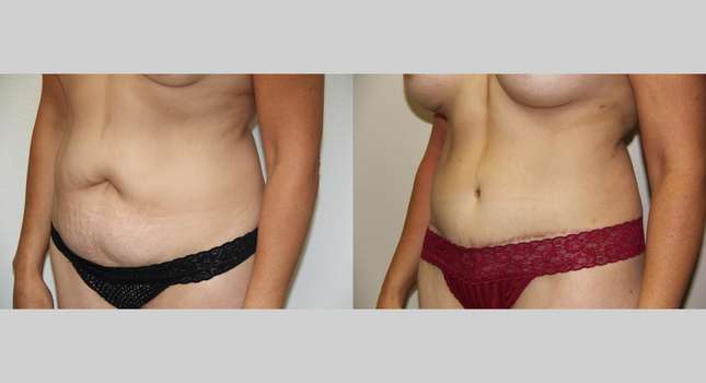 Tummy Tuck: Image #671