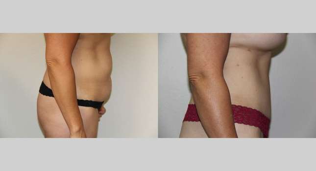 Tummy Tuck: Image #672