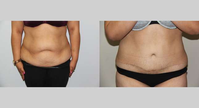 Tummy Tuck: Image #673