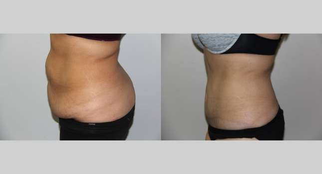 Tummy Tuck: Image #674