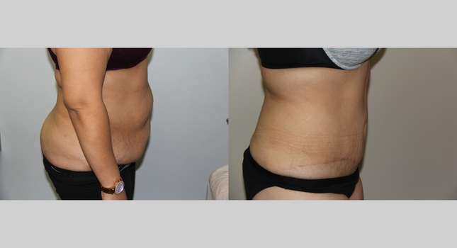 Tummy Tuck: Image #675