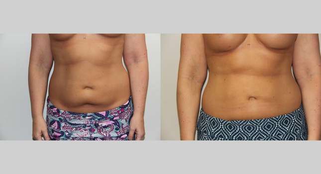 Liposuction: Image #676