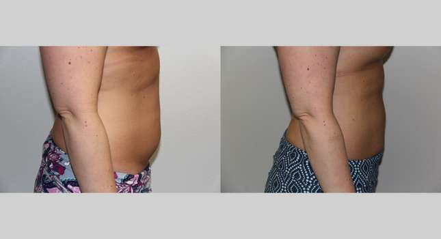Liposuction: Image #677