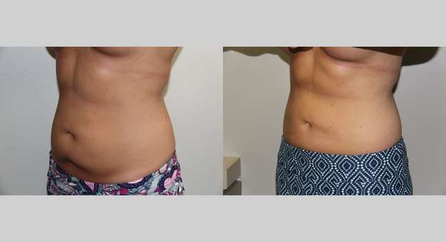 Liposuction: Image #678