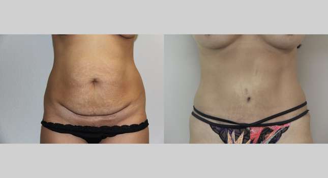 Tummy Tuck: Image #682
