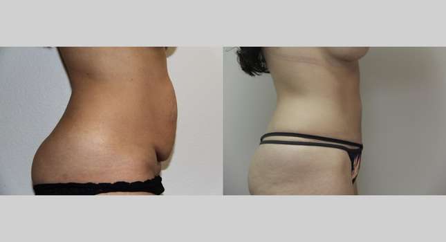 Tummy Tuck: Image #683