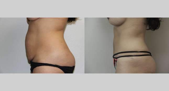 Tummy Tuck: Image #684