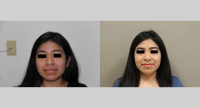 Nose Surgery: Image #685