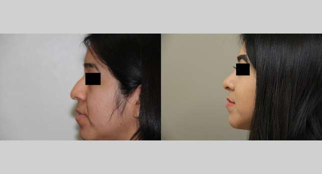 Nose Surgery: Image #686
