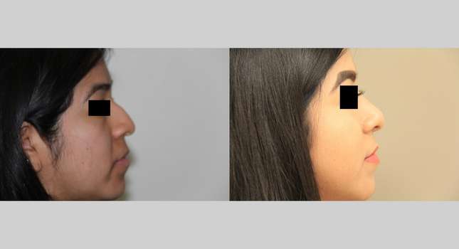 Nose Surgery: Image #687