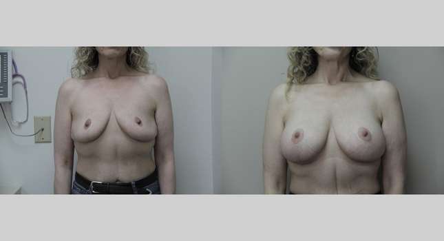 Breast Reconstruction: Image #688