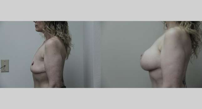 Breast Reconstruction: Image #689