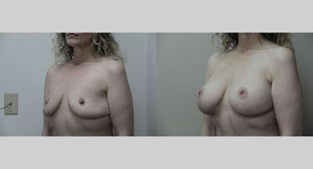 Breast Reconstruction: Image #690