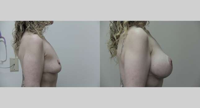 Breast Reconstruction: Image #691