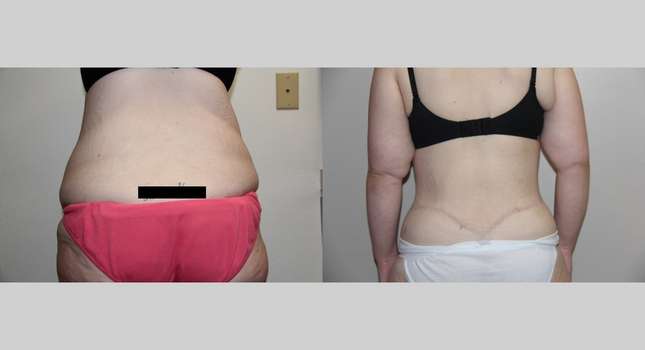 Body Lift: Image #696