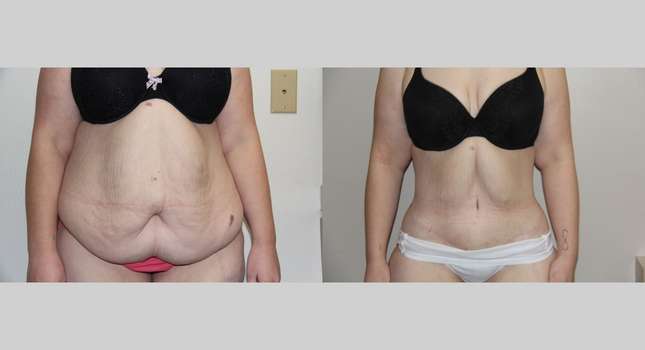 Body Lift: Image #698