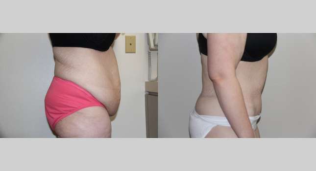 Body Lift: Image #699