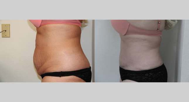 Tummy Tuck: Image #701