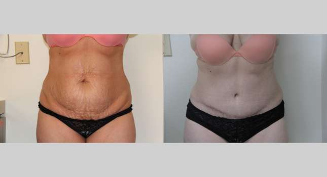 Tummy Tuck: Image #702
