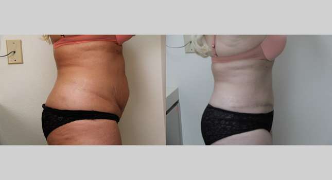 Tummy Tuck: Image #703