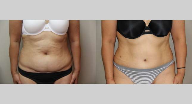 Tummy Tuck: Image #709