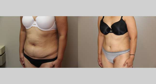 Tummy Tuck: Image #710