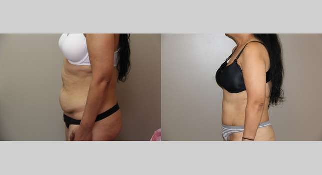 Tummy Tuck: Image #711