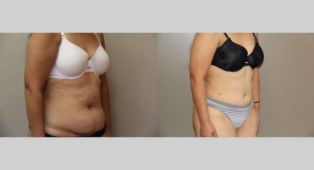 Tummy Tuck: Image #712