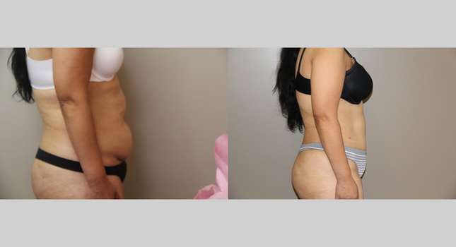 Tummy Tuck: Image #713