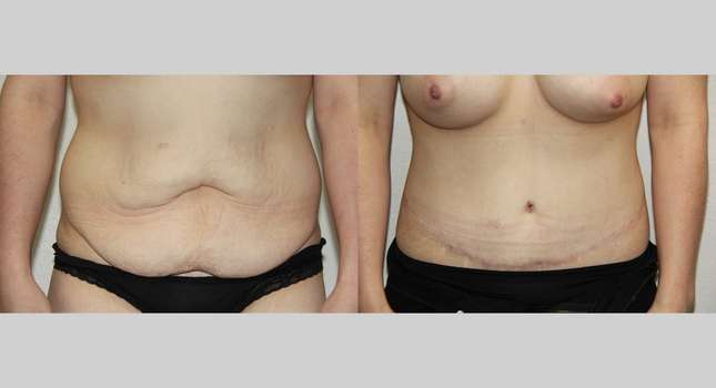 Body Lift: Image #714