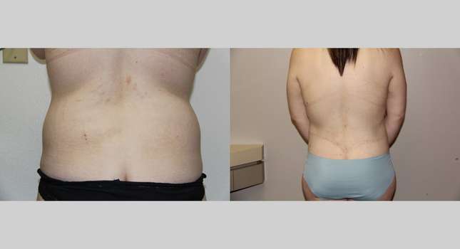Body Lift: Image #715