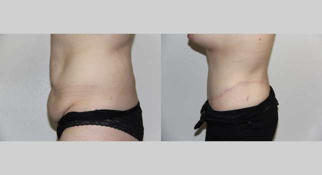 Body Lift: Image #716